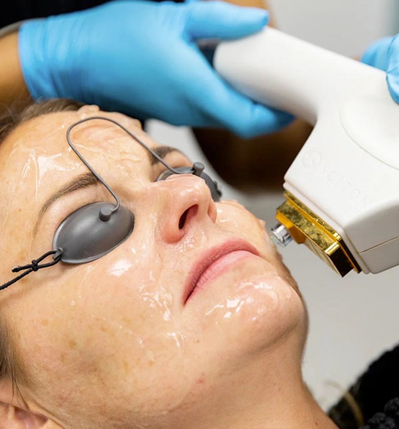 BBL Trial Treatment