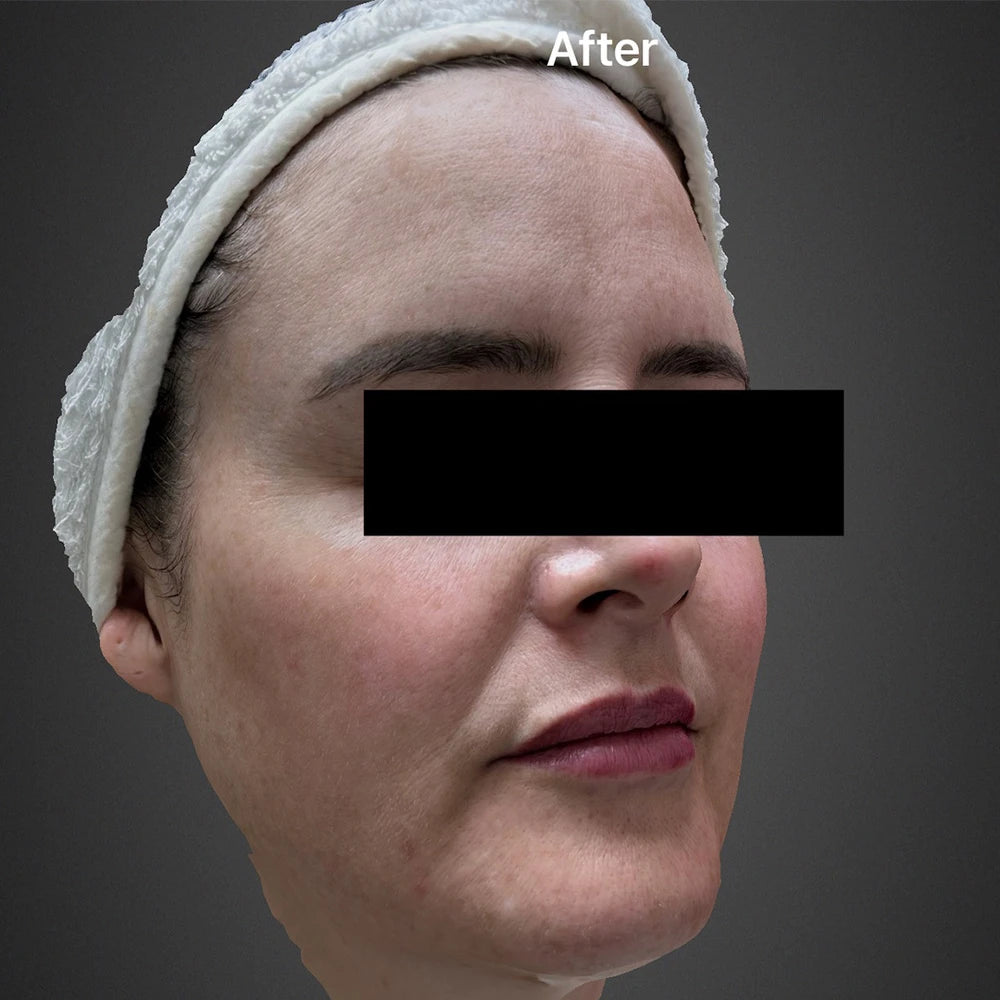 BBL Trial Treatment