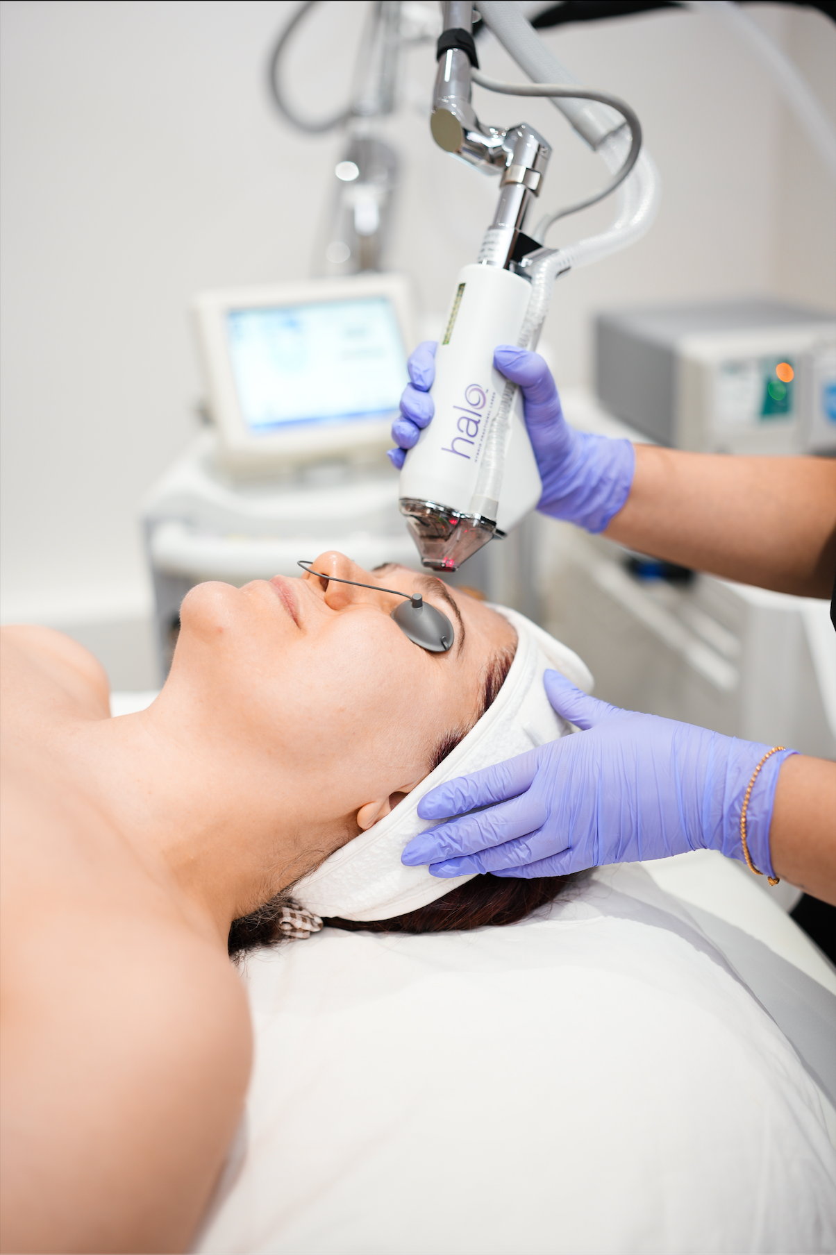 Halo Laser Resurfacing